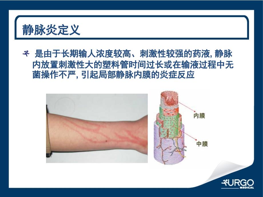 静脉炎防治_第3页