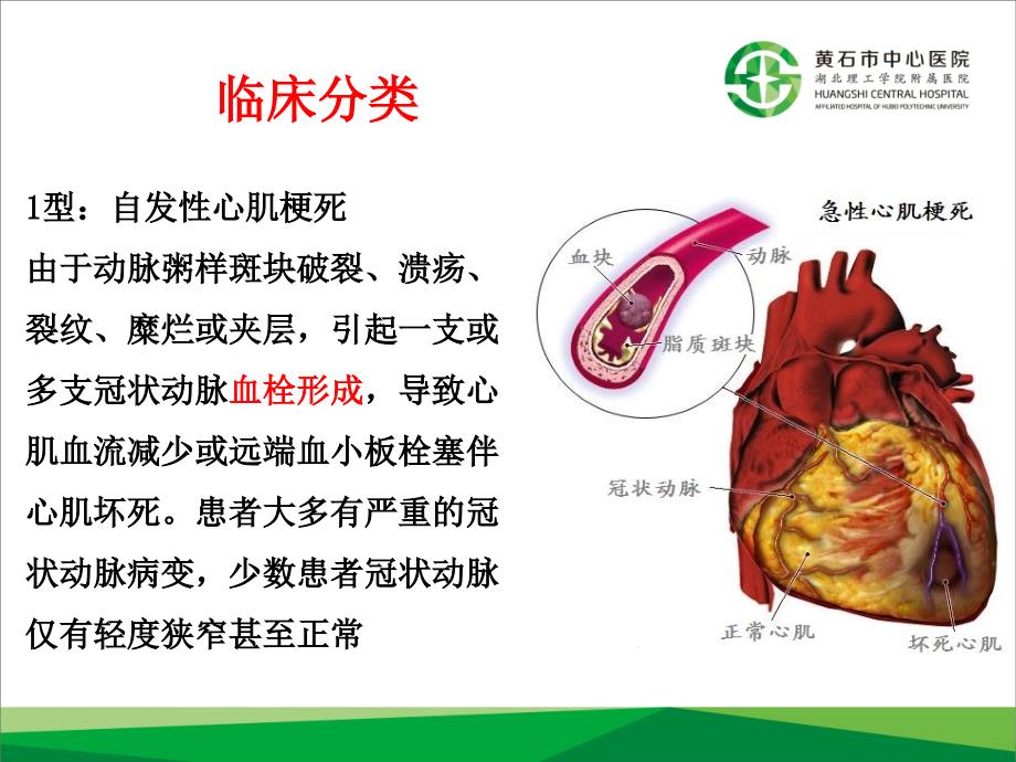 急性心肌梗死与再灌注治疗_第3页