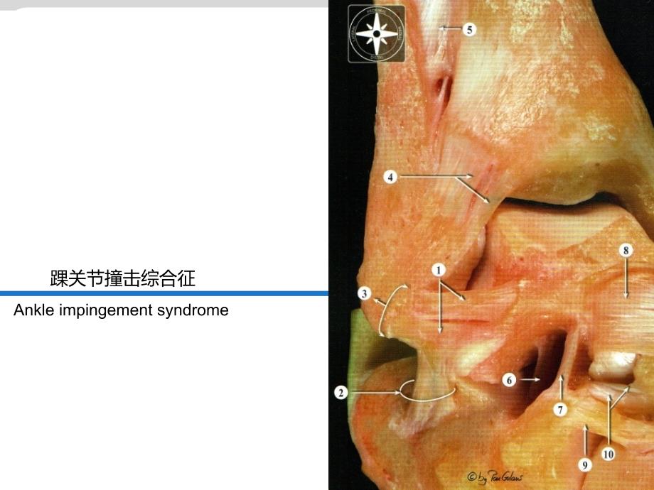 踝前撞击综合征_第1页