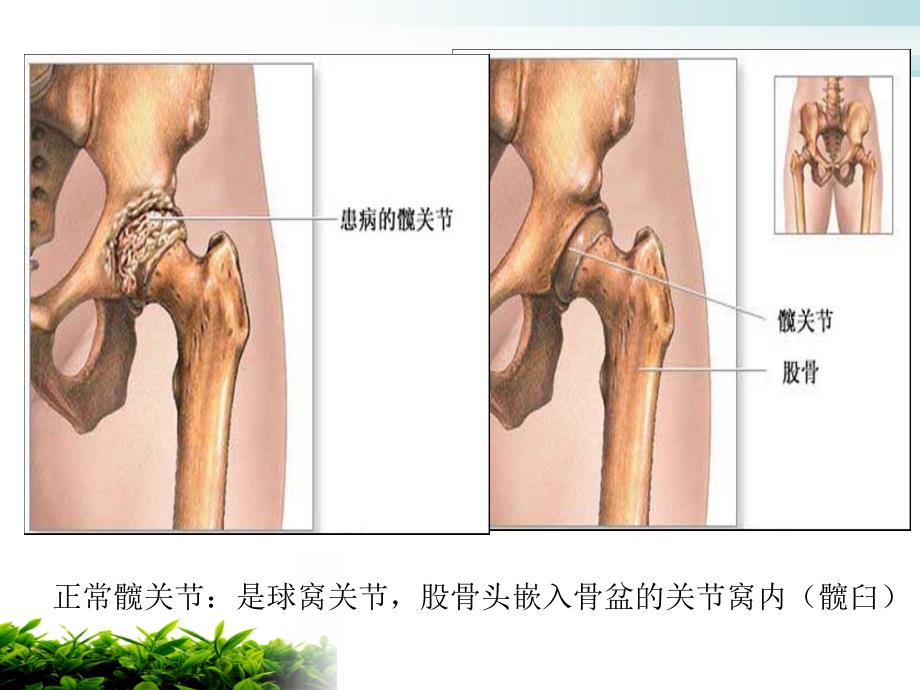 人工髋关节置换术后的护理进展_第3页