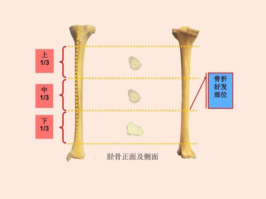 胫腓骨骨折患者的护理_第5页