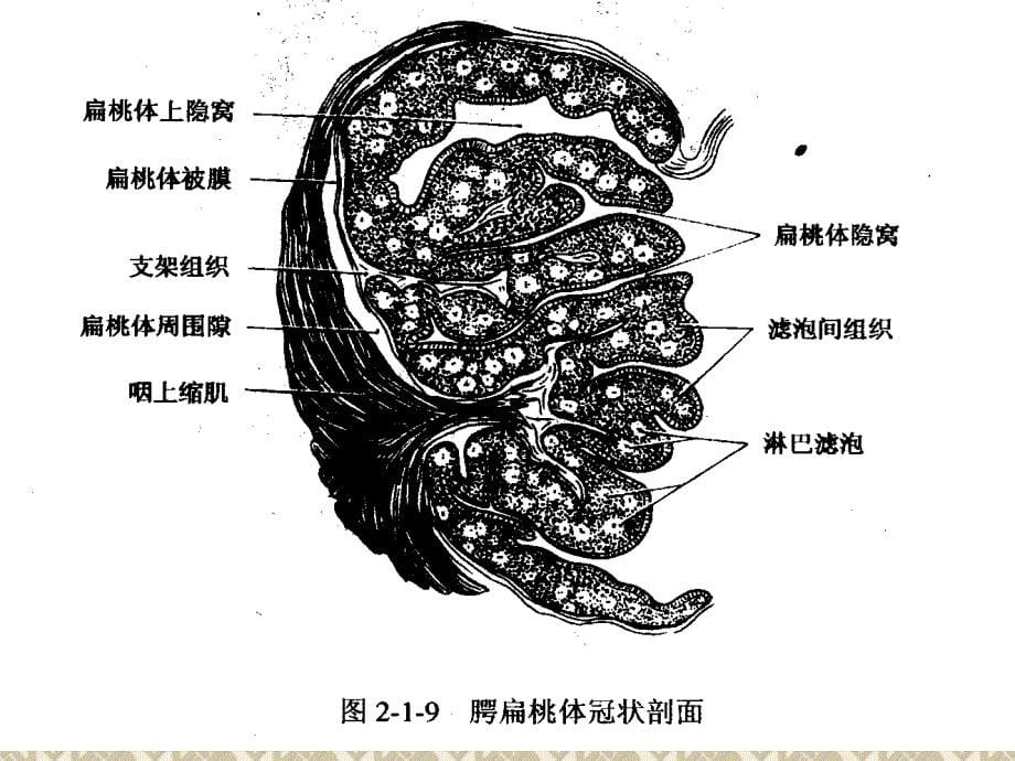 扁桃体炎围手术期的护理_第5页