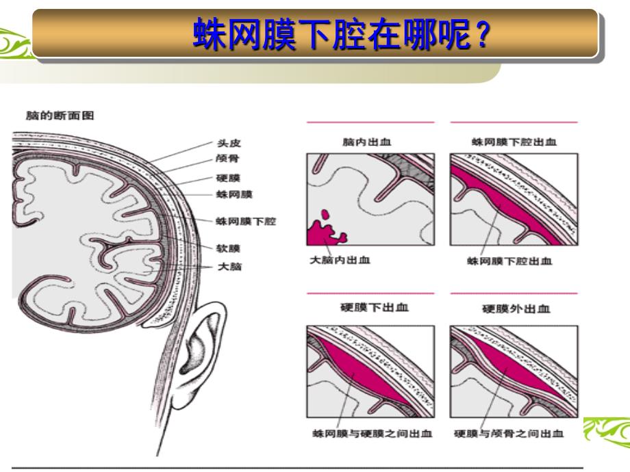 蛛网膜下腔出血课件_第3页