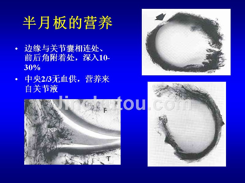 半月板损伤讲课修改版_第5页