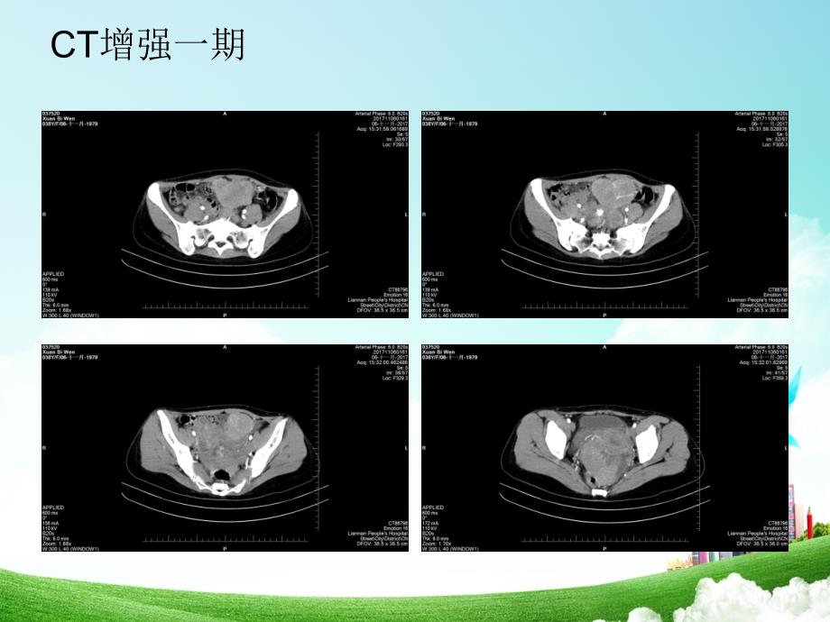 卵巢肿瘤的影像学表现_第4页