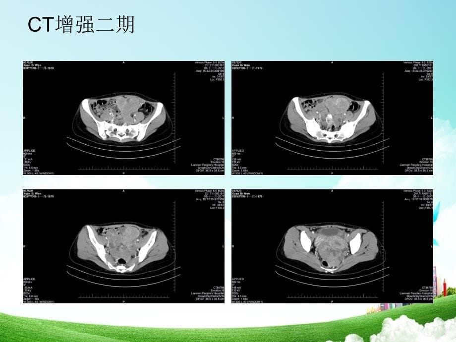 卵巢肿瘤的影像学表现_第5页