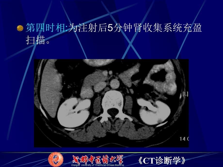 肾CT检查与肾肿瘤_第5页