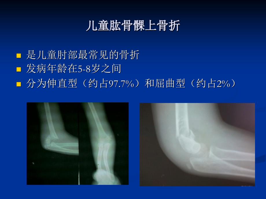 儿童肘关节创伤的诊断和治疗_第2页