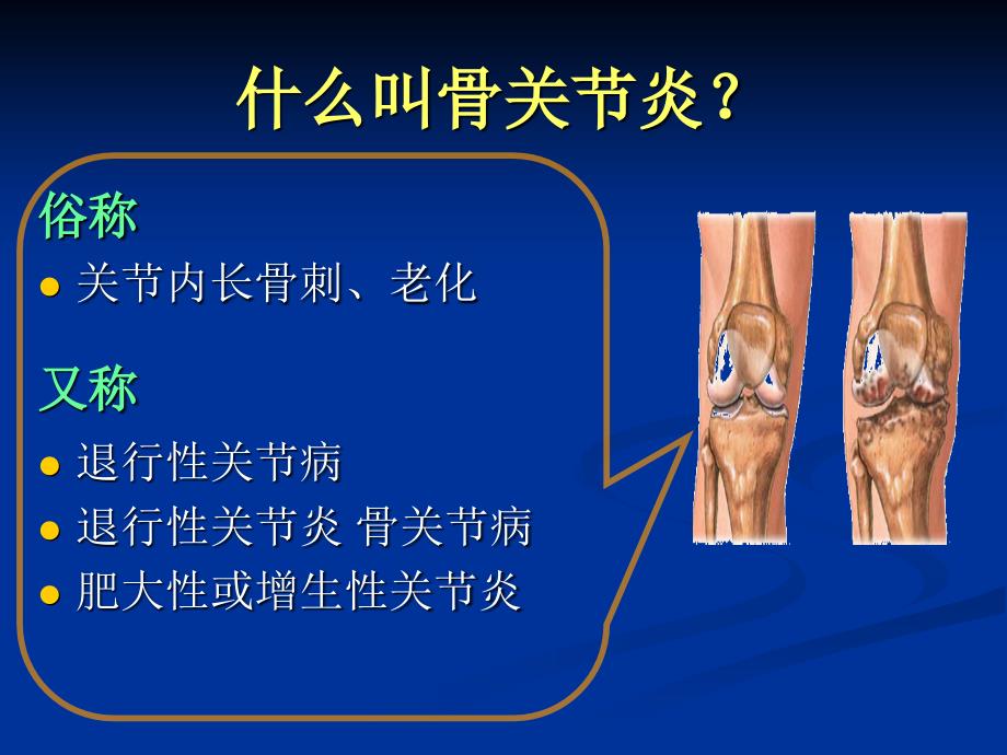 膝关节骨性关节炎的分级治疗_第2页