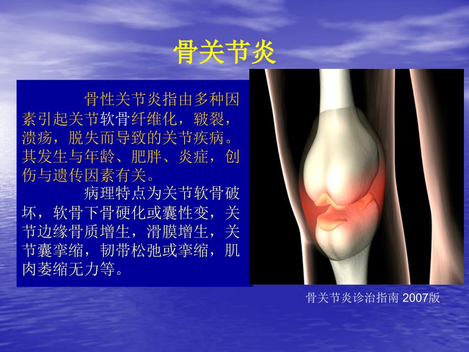 膝关节骨性关节炎的分级治疗_第3页