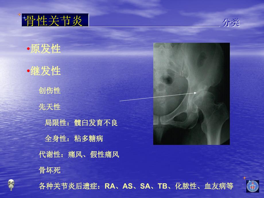 膝关节骨性关节炎的分级治疗_第4页