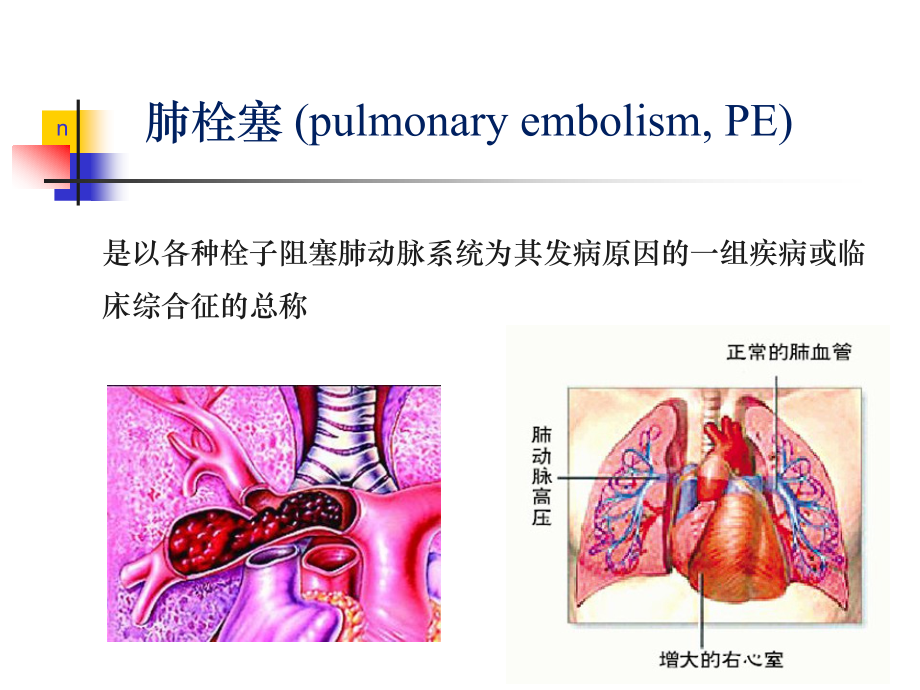 肺栓塞的发病机制、诊断和处理_第2页