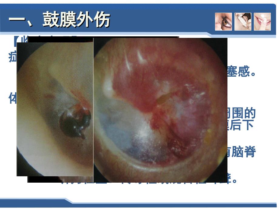 五官科学-第六章耳鼻咽喉科常见疾病5耳部疾病1_第4页