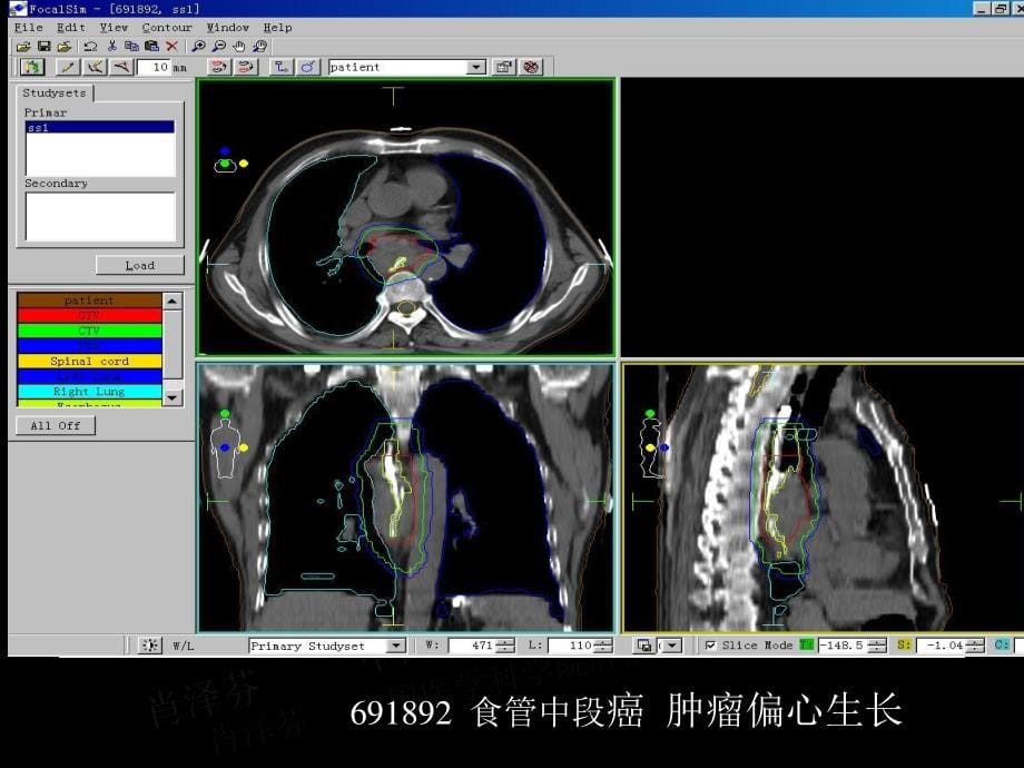 食管癌3DRT靶区勾画建议与原则_第5页