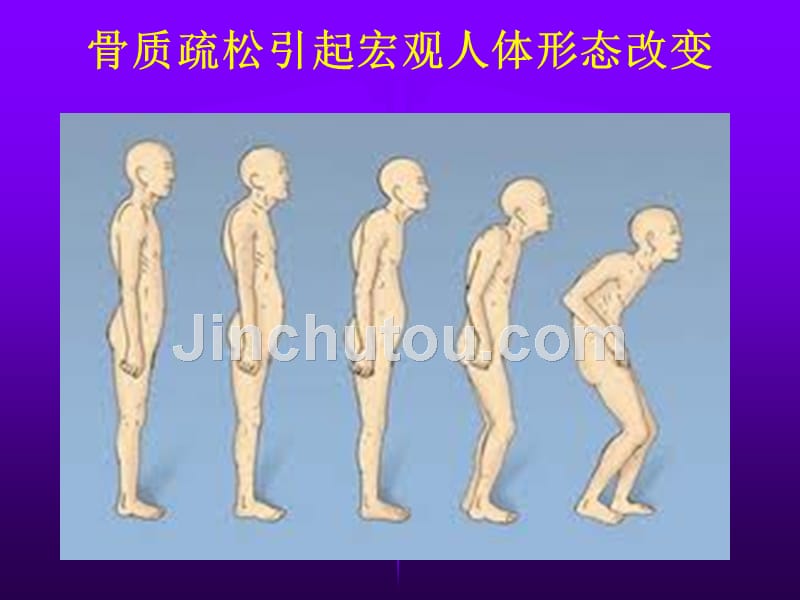 骨质疏松的分子生物学研究_第3页