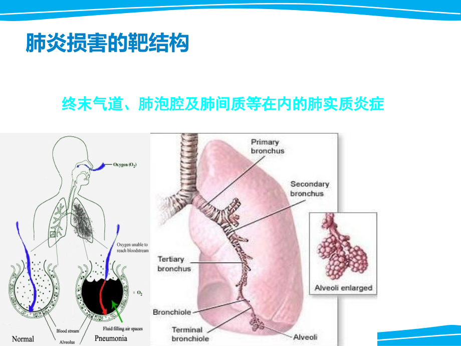 严重肺部感染诊治策略_第3页