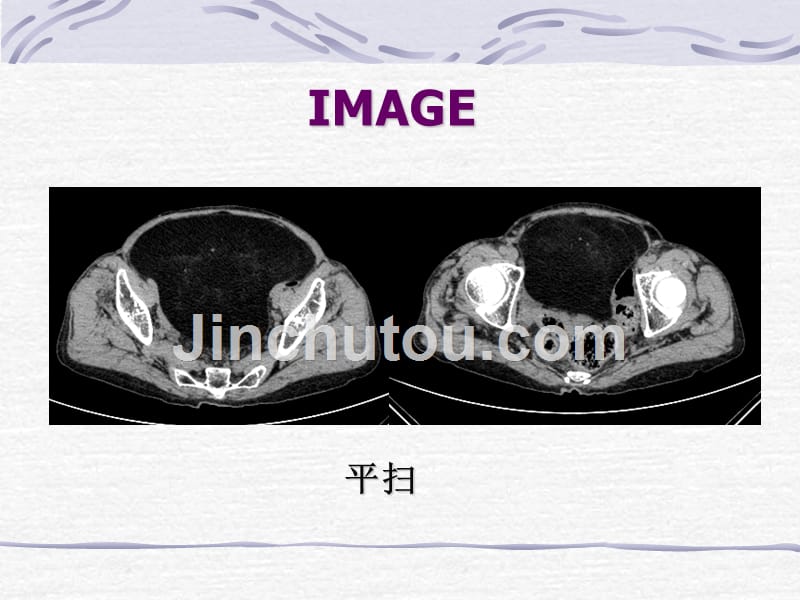 脂肪肉瘤一例CT表现_第3页