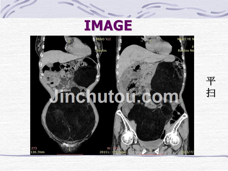 脂肪肉瘤一例CT表现_第4页