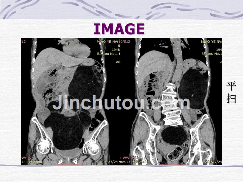 脂肪肉瘤一例CT表现_第5页