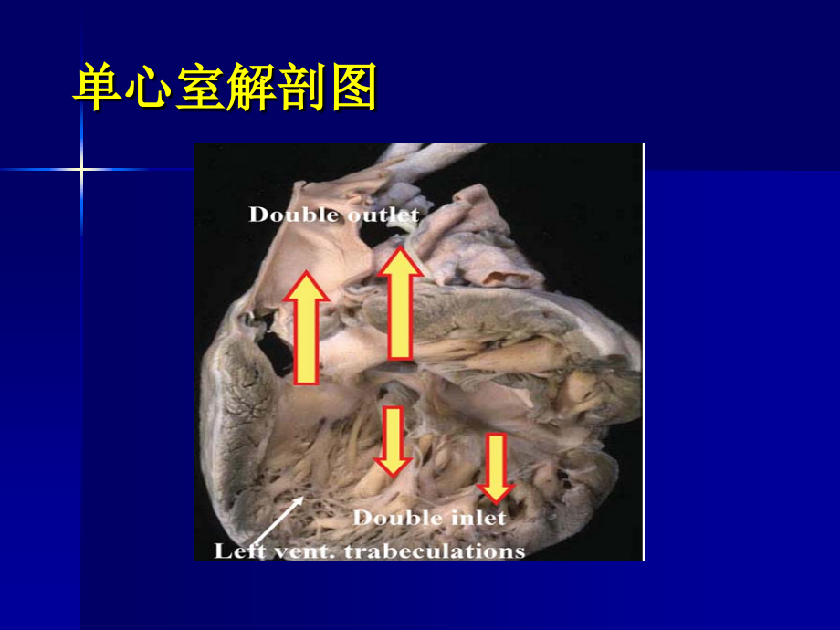 单心室 (单一心室房室连接)_第3页