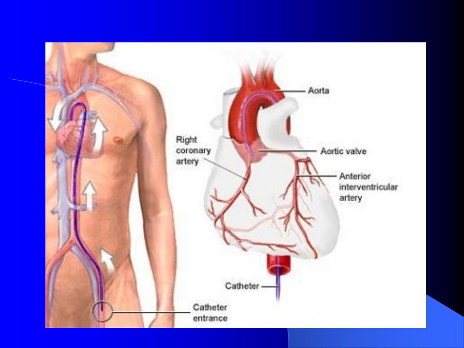 冠心病介入治疗的术前准备和术后处理_第2页