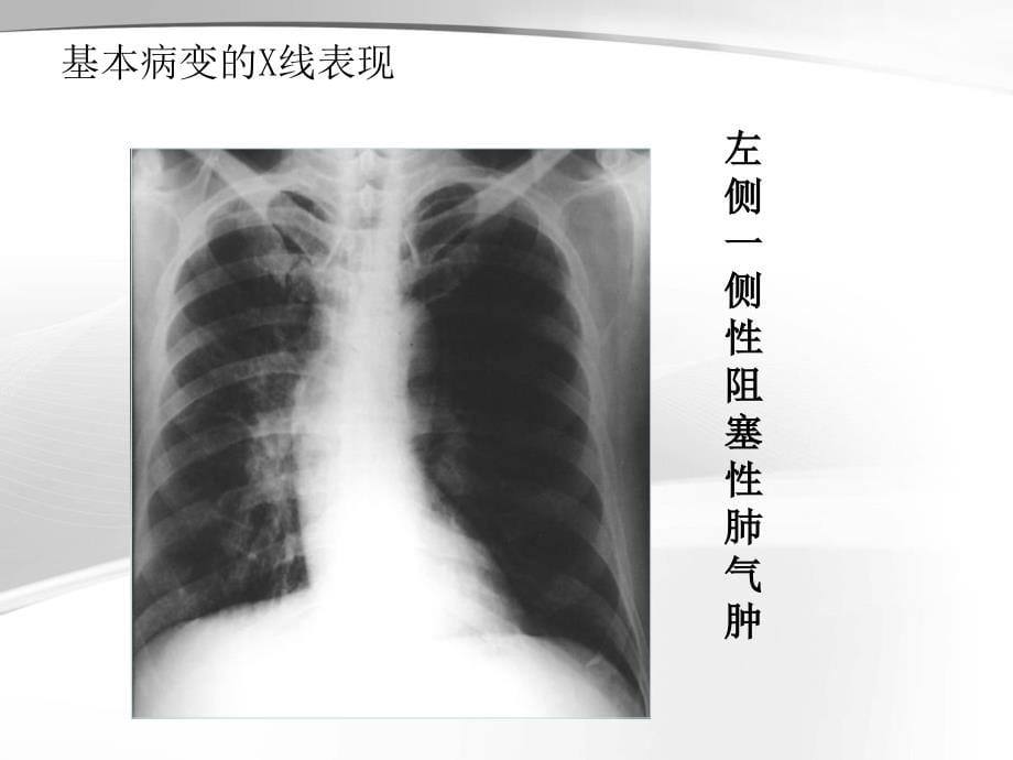 呼吸系统的异常影像学表现_第5页