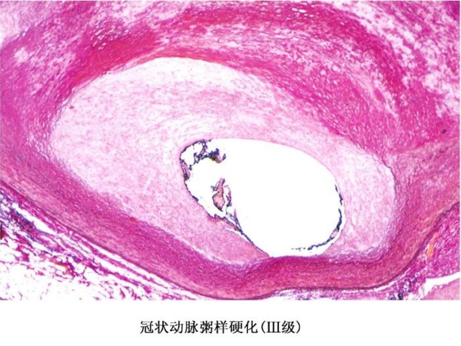 病理生理学冠心病_第4页