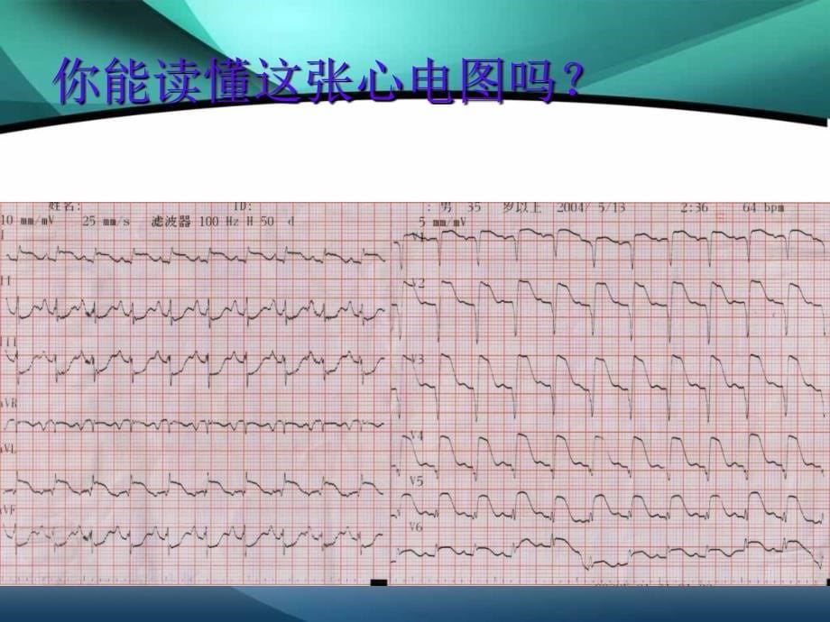 急性心肌梗死的治疗_第5页