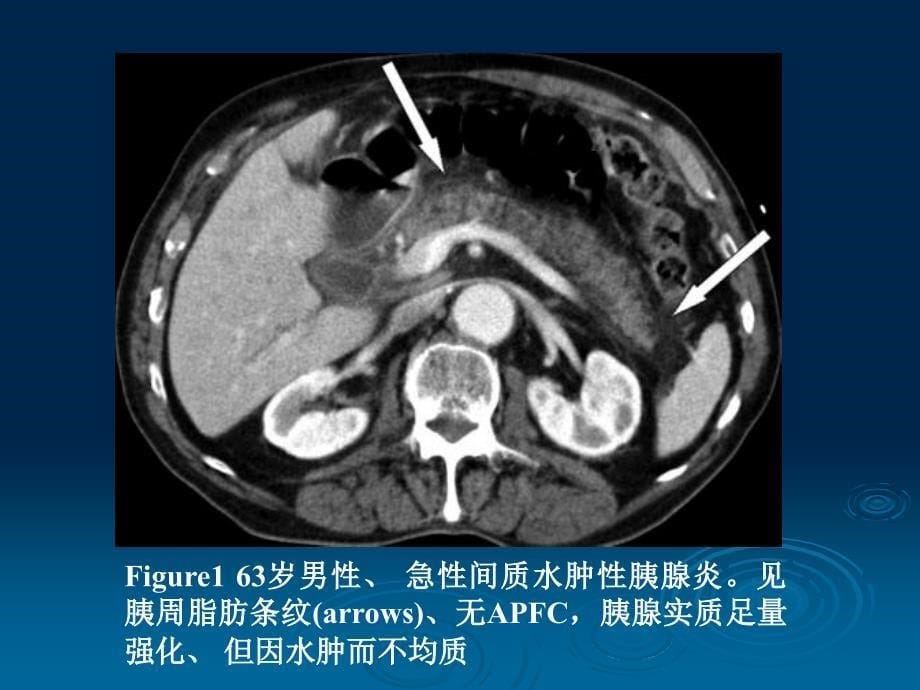 急性胰腺炎及其并发症诊断相关规范_第5页