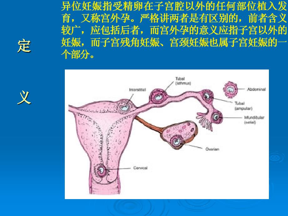 妊娠黄体与宫外孕的鉴别诊断_第3页