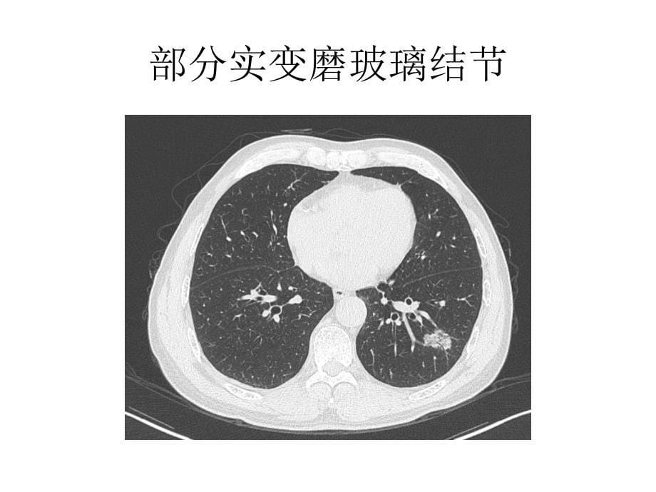 肺结节处理指南_第5页