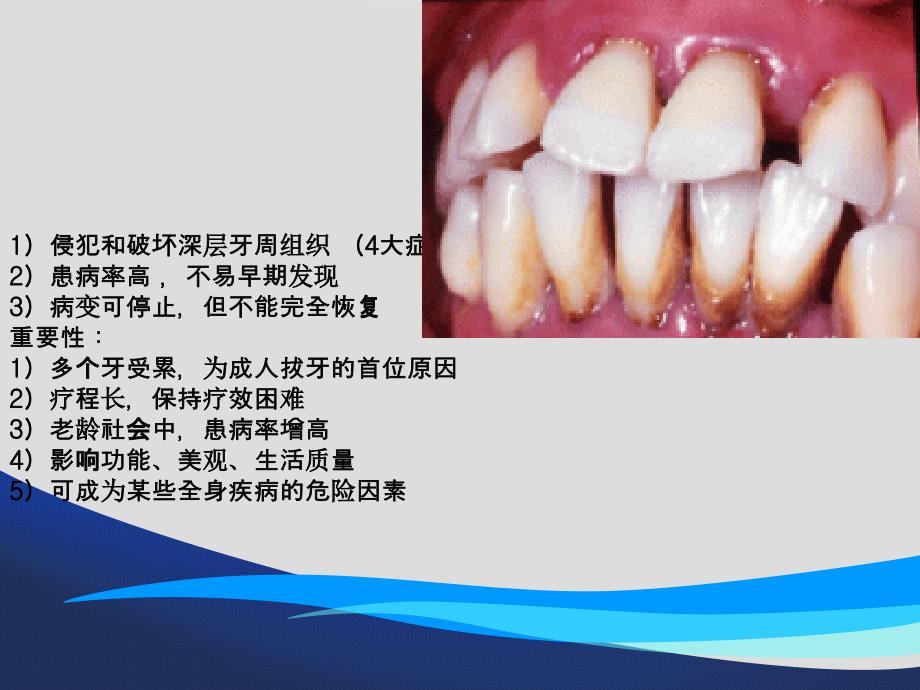 慢性牙周炎的诊断_第2页