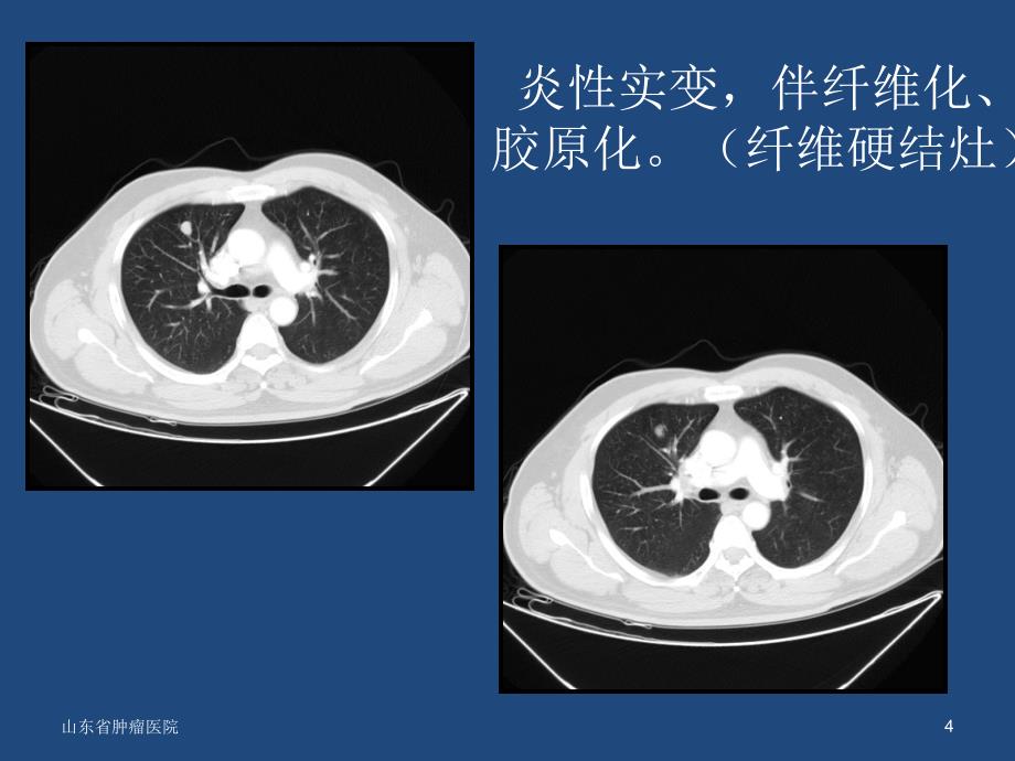 肺结节的诊疗决策_第4页