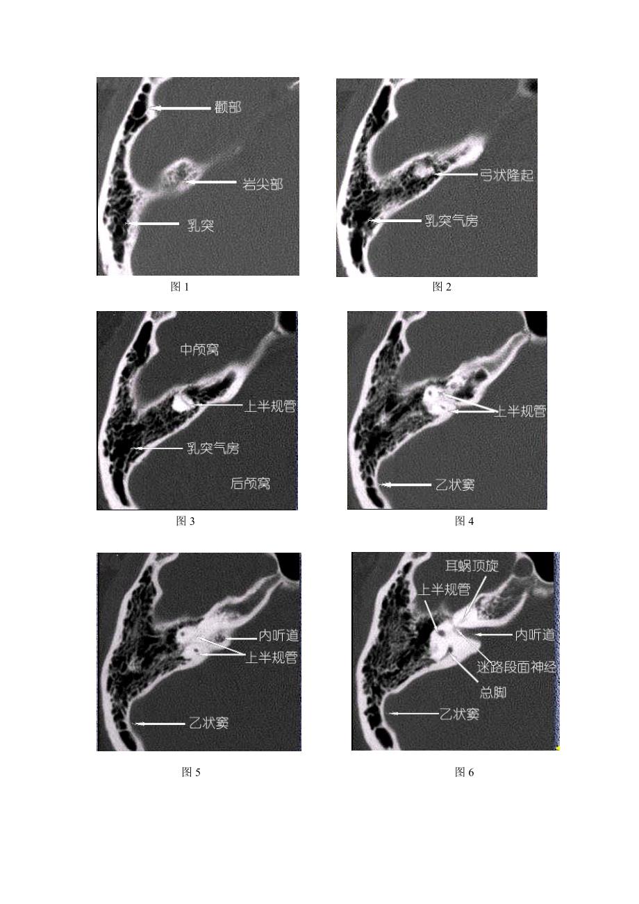 耳部CT及MRI解剖_第1页