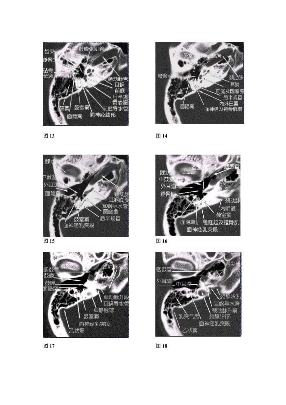 耳部CT及MRI解剖_第5页