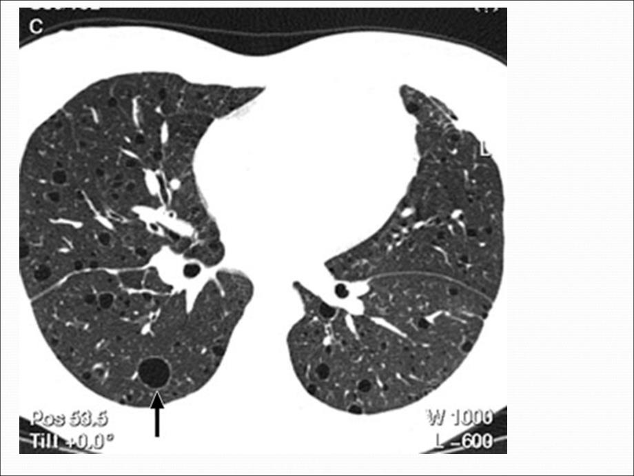 淋巴管肌瘤病的肺部CT表现_第3页