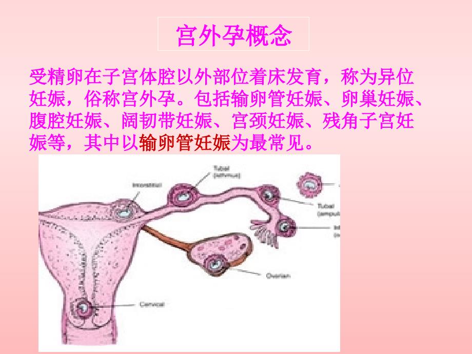 宫外孕个案查房_第4页