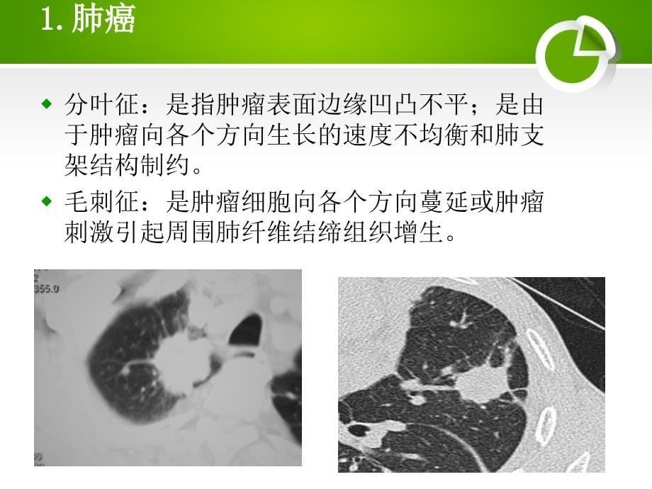 孤立性肺结节的影像学诊断和鉴别诊断_第5页