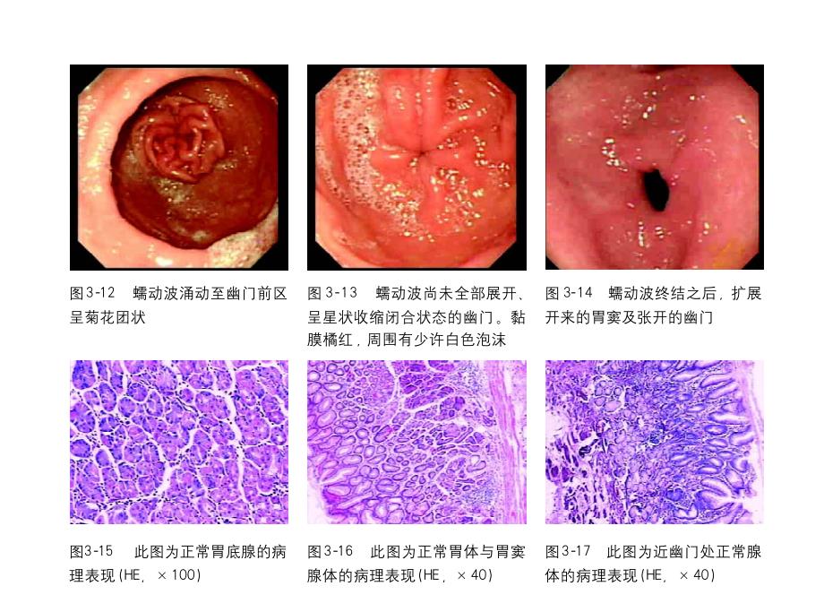 胃疾病的形态学诊断与病理_第3页