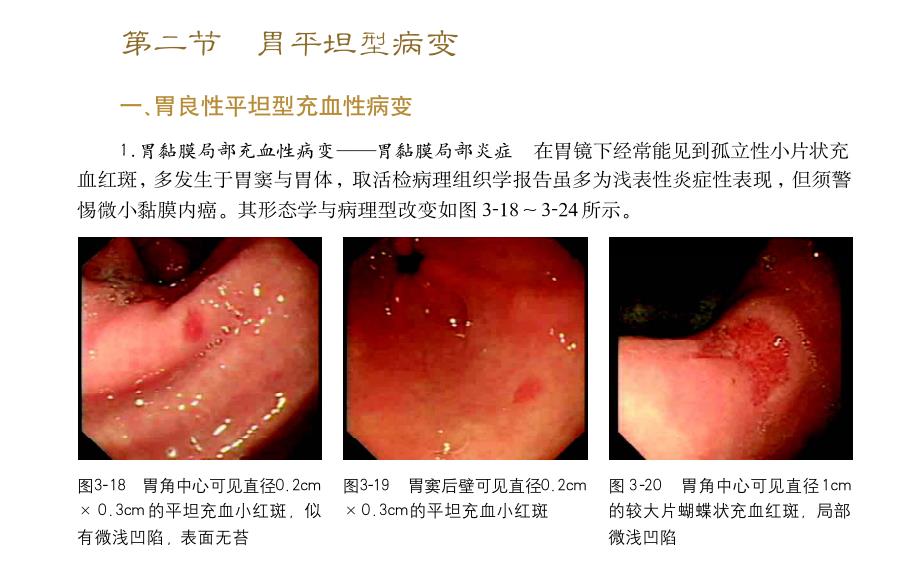 胃疾病的形态学诊断与病理_第4页