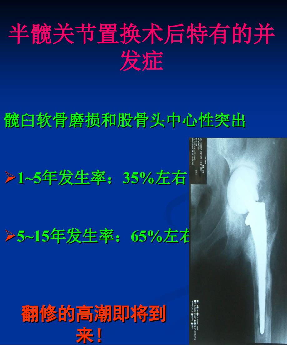 髋关节假体的选择_第3页