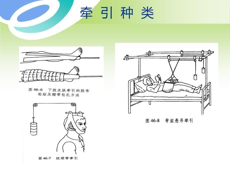 骨科牵引术的护理_第5页