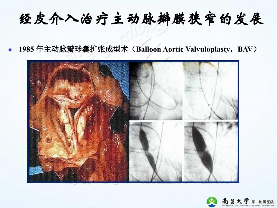 经导管主动脉瓣置换术中国专家共识_第3页