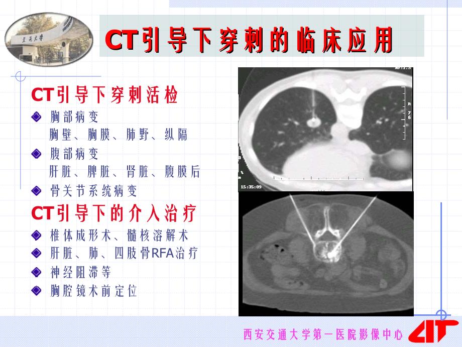 CT引导下穿刺的临床应用_第3页