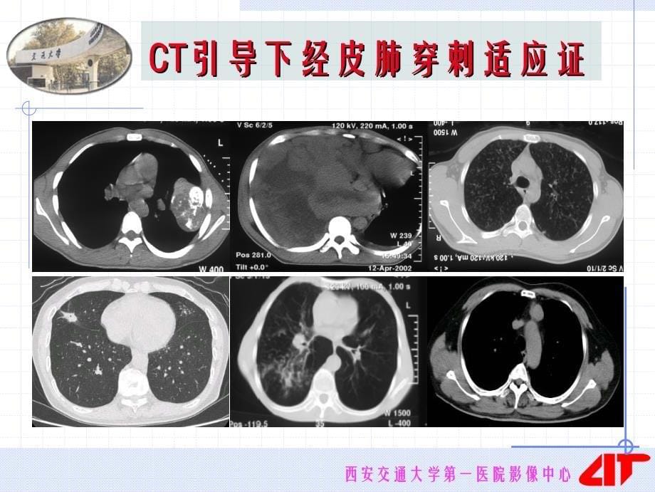 CT引导下穿刺的临床应用_第5页