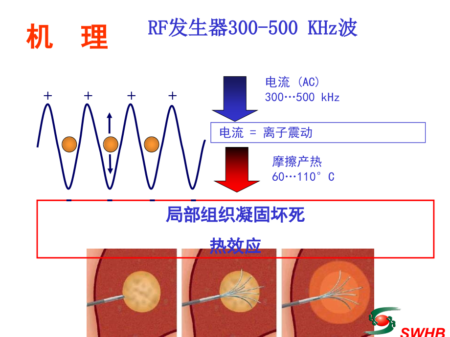 肝肿瘤射频消融治疗的最新进展_第2页