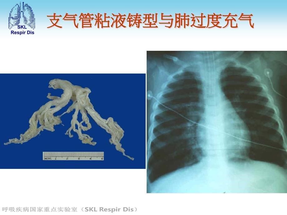 危重哮喘机械通气与雾化吸入_第5页