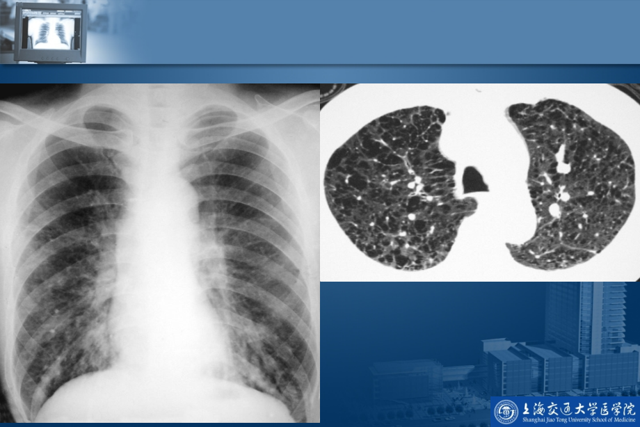 呼吸系统疾病的影像学诊断_第3页