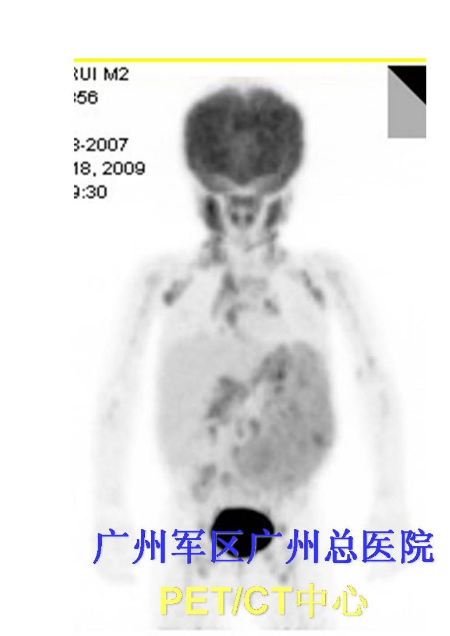 淋巴结指突状细胞肉瘤_第2页