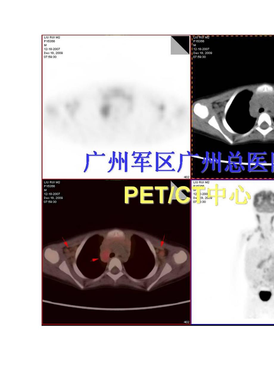 淋巴结指突状细胞肉瘤_第3页